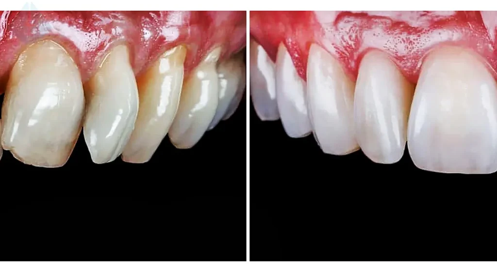 Before and after using a porcelain veneer as a chipped tooth solution
